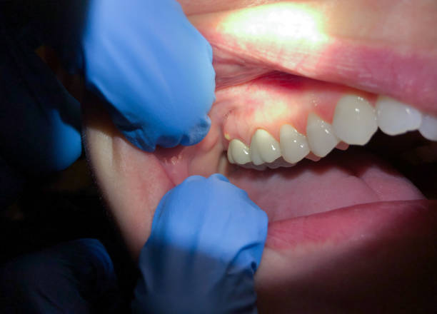 Best Emergency Dental Care for Broken or Chipped Teeth in Noble, OK